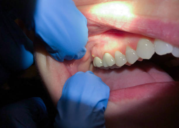 Best Emergency Treatment for Dental Infections or Abscesses in Wolverine Lake, MI