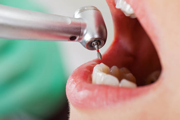 Best Urgent Care for Lost Fillings or Crowns in Wolverine Lake, MI